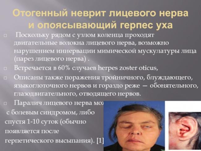 Парез лицевого нерва: причины, симптомы, лечение медикаментами и в домашних условиях, а также меры профилактики