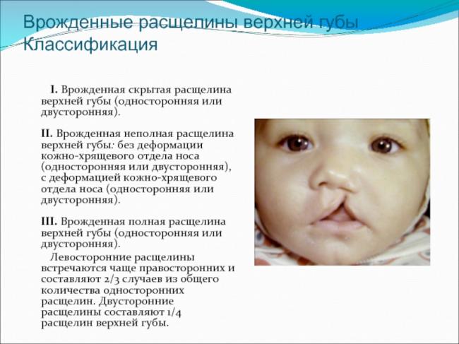 Заячья губа у человека причины. хейлосхизис (волчья пасть, заячья губа): что это, причины возникновения, симптомы, фото детей до и после операции