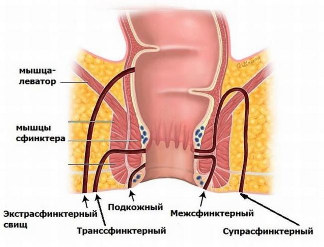 Парапроктит. причины, симптомы, признаки, диагностика и лечение патологии. :: polismed.com