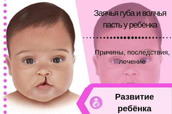 Волчья пасть у детей: причины, операция
