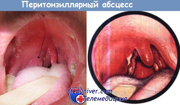 Причины, симптомы и лечение паратонзиллярного абсцесса