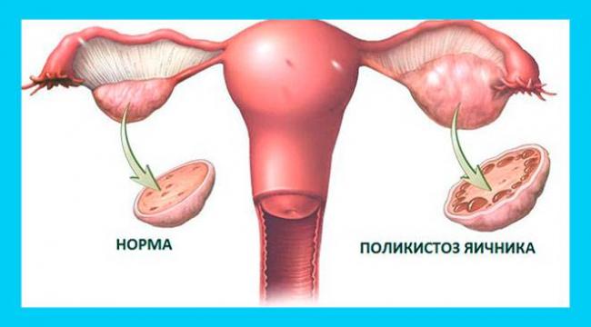 Поликистоз яичников (спкя): симптомы, причины, лечение