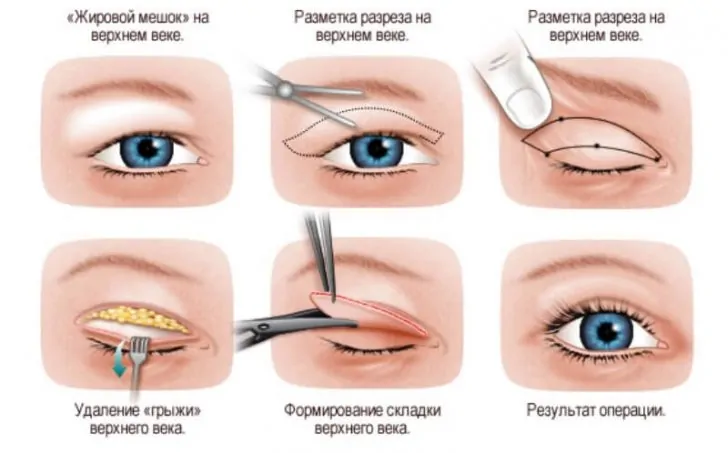 Грыжи под глазами: лечение и профилактика, удаление