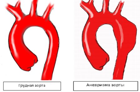 Аневризма брюшной аорты – большой обзор болезни