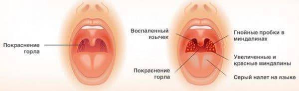 Хронический тонзиллит - на всю жизнь?