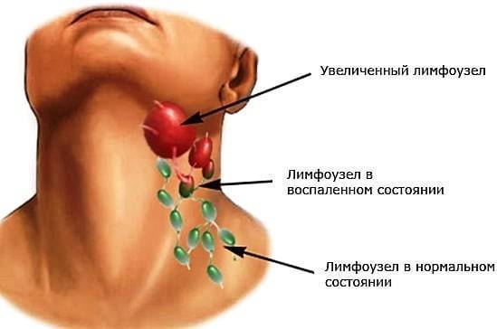 Туберкулез лимфоузлов: особенности протекания и лечение