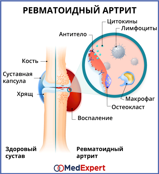 Cимптомы ревматоидного артрита у женщин: особенности проявления