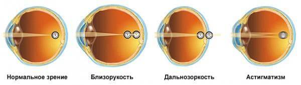 Ухудшение зрения: почему падает после 40-45 лет и что с этим делать?