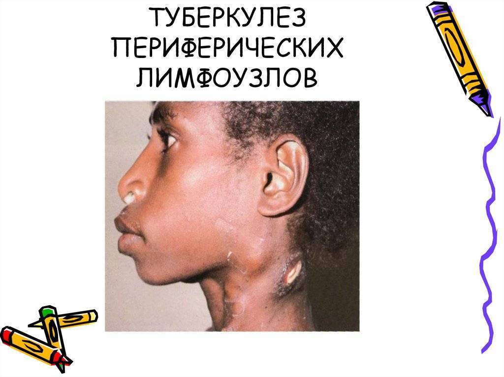 Туберкулёз лимфоузлов
