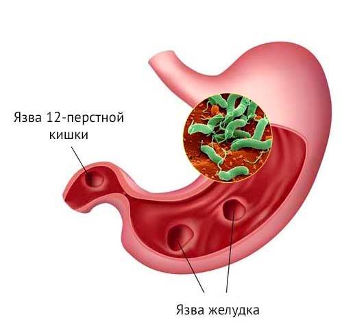 Лечение хеликобактер пилори: подробная схема лечения