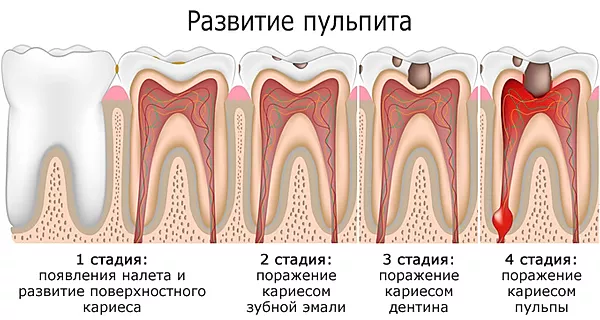 Обострение хронического пульпита, стадии, лечение