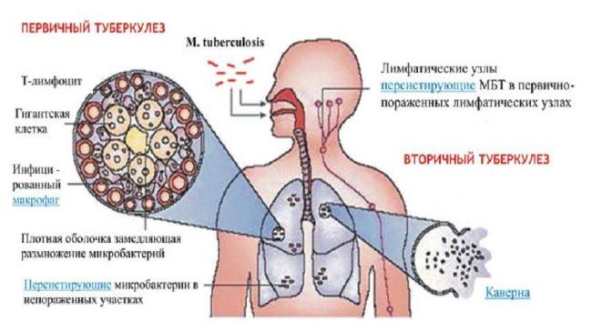 Туберкулез: пути передачи, симптомы, профилактика