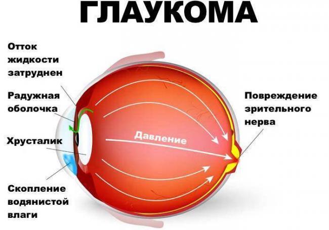 После замены хрусталика глаз видит мутно - причины и что делать