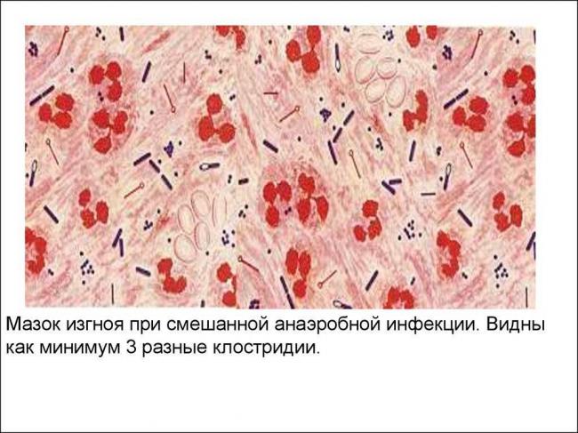 Клостридия: патогенность, формы клостридиоза, симптомы, диагностика, лечение
