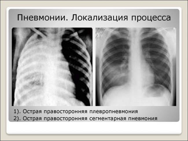 Пневмонии (воспаление легких).