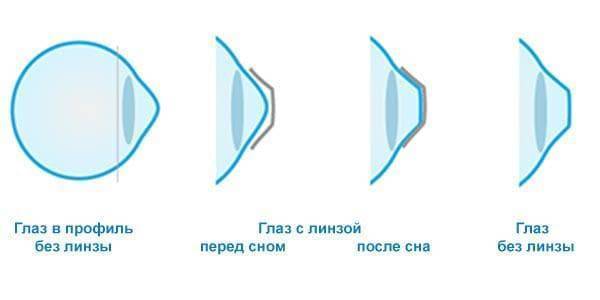 Ортокератология: годовой опыт использования ночных линз