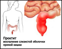 Эрозивный проктит: симптомы и лечение, что это, диета, свечи при эрозивном проктите