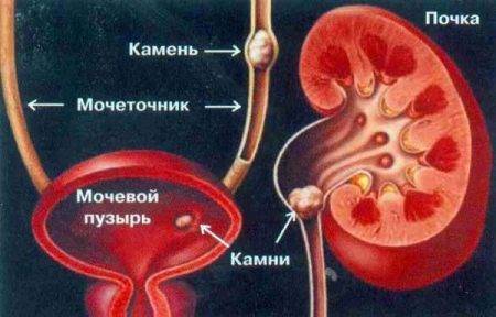 Обнаружено в моче большое количество бактерий: что это значит, чем лечить