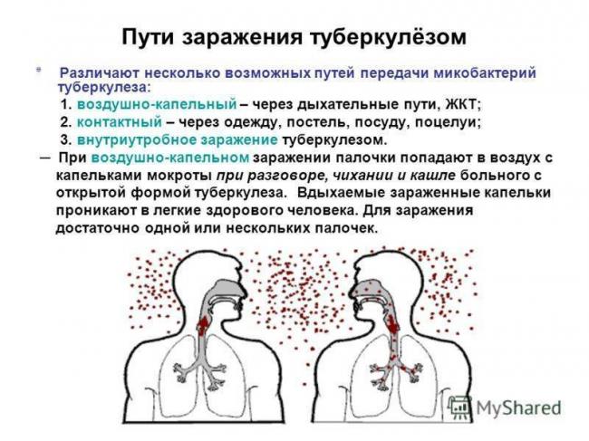 Инфильтративный туберкулез в фазе распада: что это такое, заразен он или нет