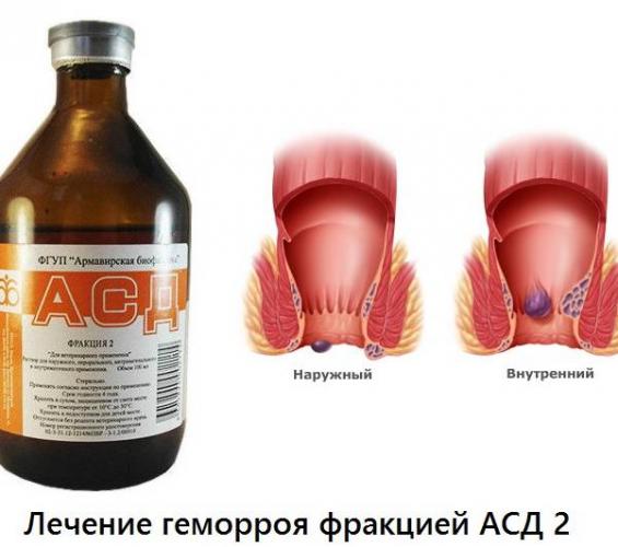 Асд 2 — тонкости применения при туберкулезе