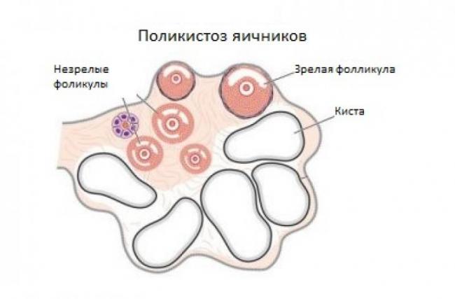 Спкя синдром поликистозных яичников - физиотерапия при спкя - запись пользователя ирина (jlika15) в сообществе зачатие в категории статьи, полезная информация - babyblog.ru