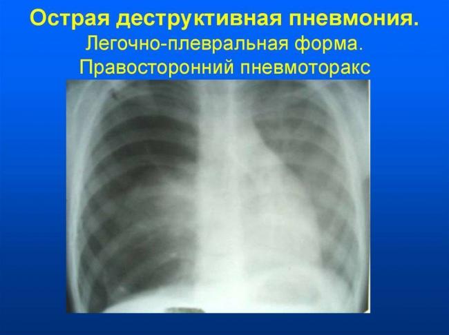 Пневмония | симптомы | диагностика | лечение - docdoc.ru