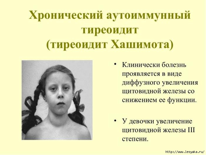 Причины и лечение хронического тиреоидита