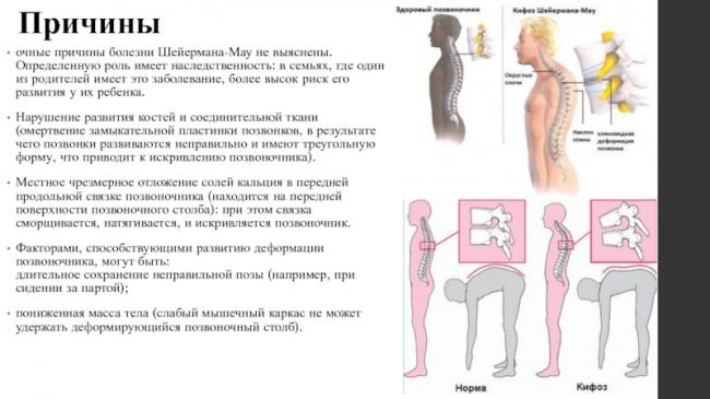 Что такое болезнь шейермана-мау