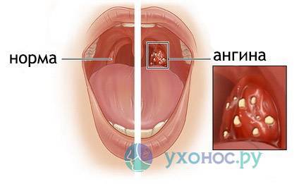 Атрофический фарингит: симптомы и современное лечение