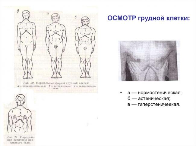 Грудная клетка неправильной формы