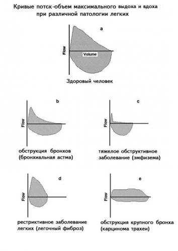 Спирометрия - что это такое и какие нормальные показатели (таблица)