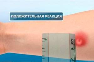 Как интерпретировать папулу при диаскинтесте?