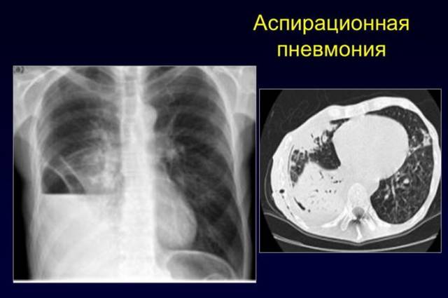 От чего может быть пневмония у новорожденных? причины и возможные последствия