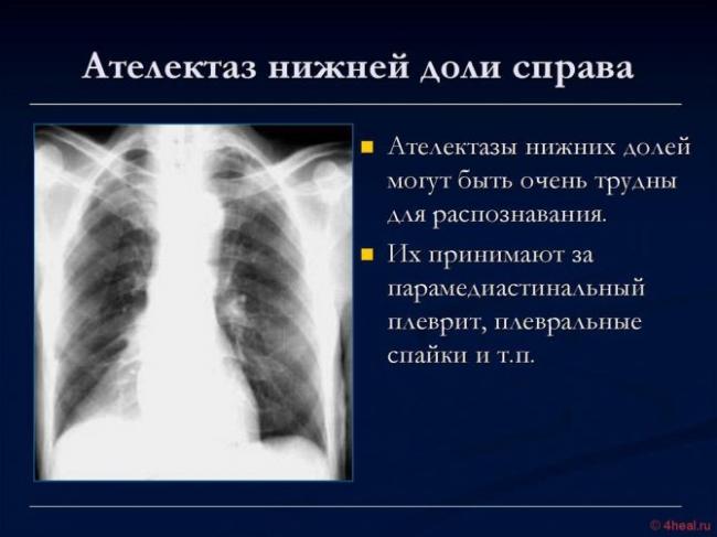 Ателектаз