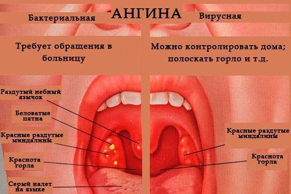 Вирусная ангина – симптомы, лечение. как отличить вирусную ангину от бактериальной?