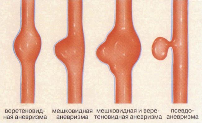 Аневризма брюшной аорты. причины, симптомы, признаки, диагностика и лечение патологии