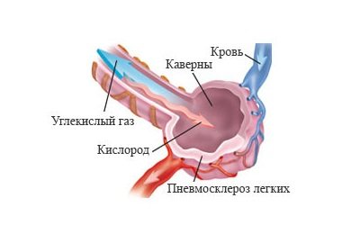 Диффузный пневмосклероз: лечение и профилактика