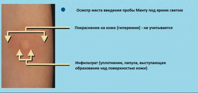 Отрицательная манту