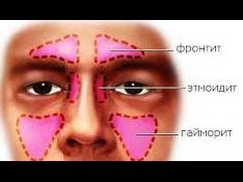 Катаральный фронтит (воспаление лобных пазух)