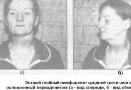 Мкб 10 – неспецифический лимфаденит (i88)