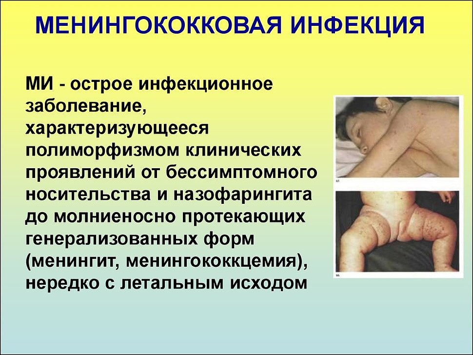 Менингококковая инфекция у детей - симптомы, лечение, фото, профилактика, признаки