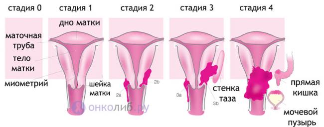 Неправильное питание, как причина возникновения рака