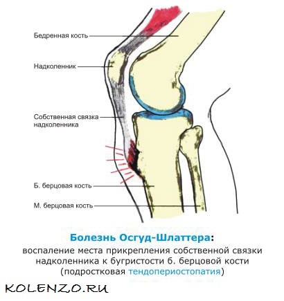 Болезнь шляттера коленного сустава у подростка лечение