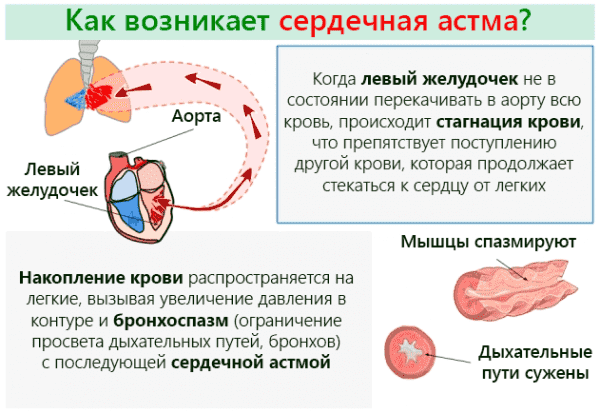 Классификация бронхиальной астмы
