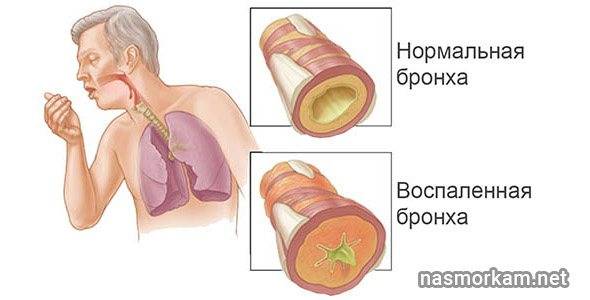 Откашливание мокроты с кровью – насколько это опасно?