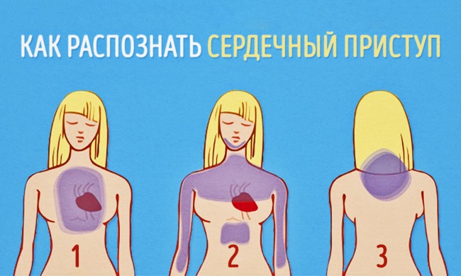 Симптомы предынфарктного состояния
