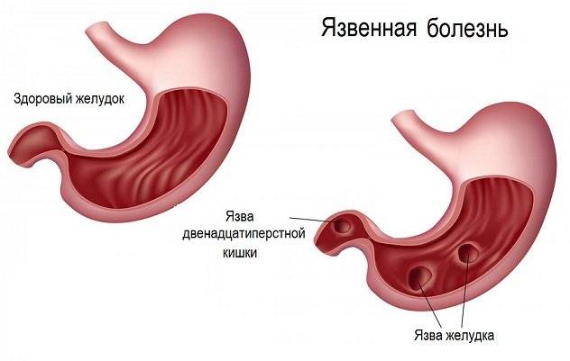 Лечение хеликобактер пилори: подробная схема лечения