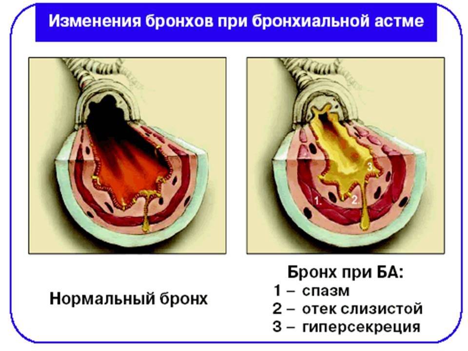 Передается ли астма по наследству