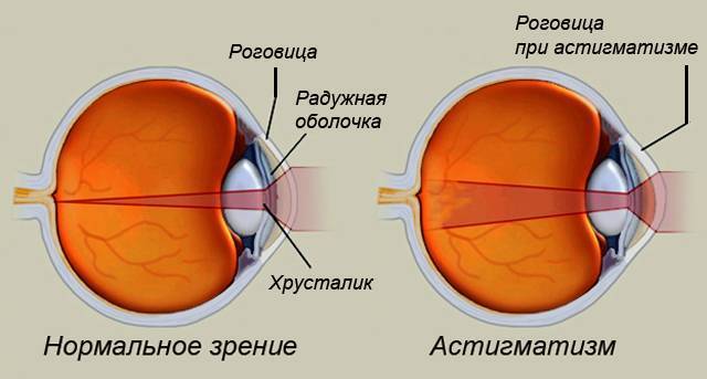 Можно ли при астигматизме носить обычные линзы