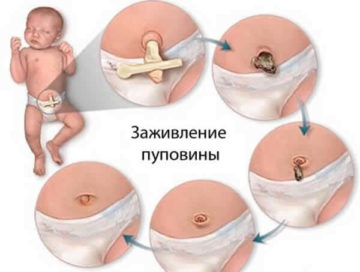 Мокнет пупок у новорожденного, что делать